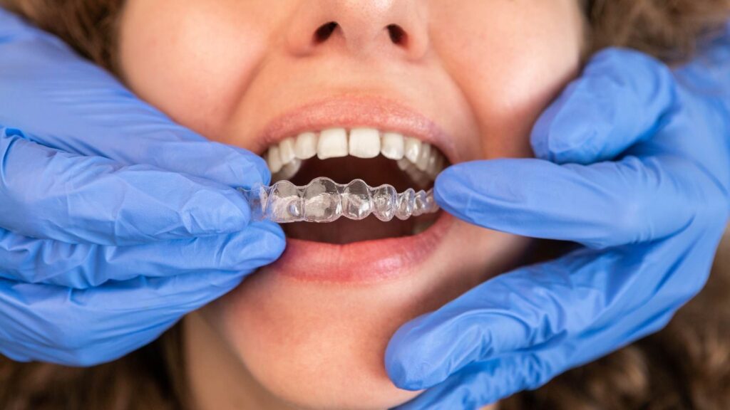invisalign